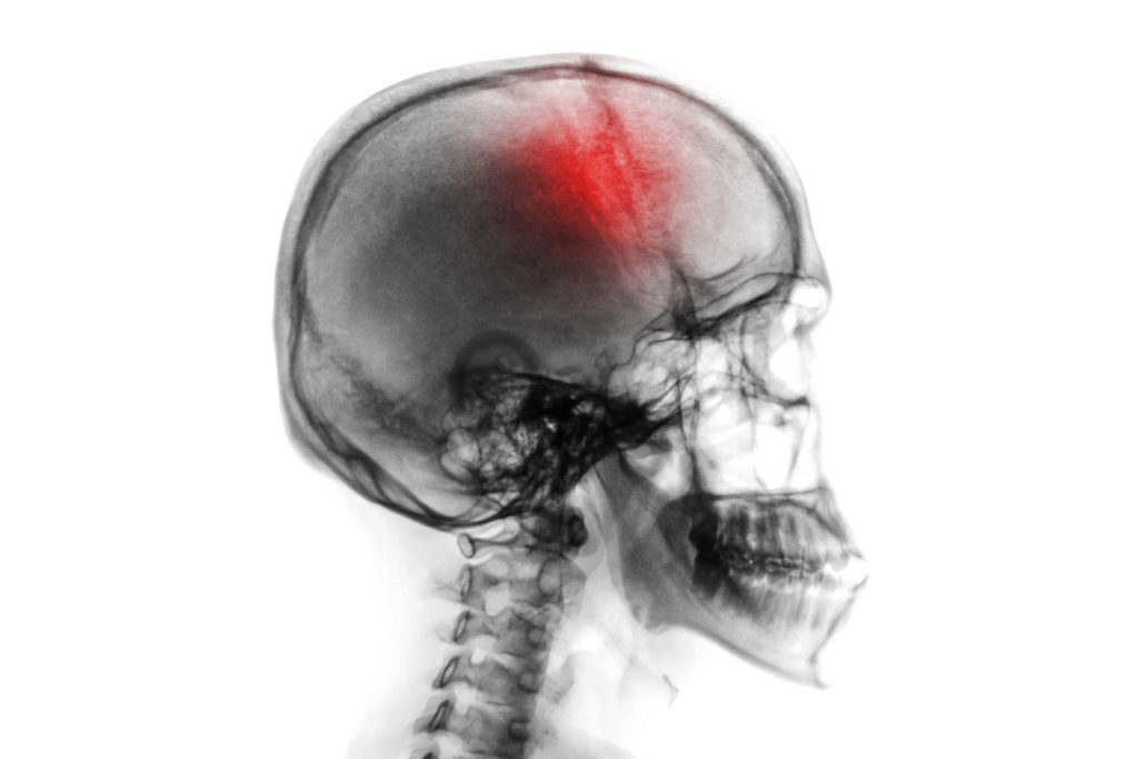Las Vegas brain injury lawyer